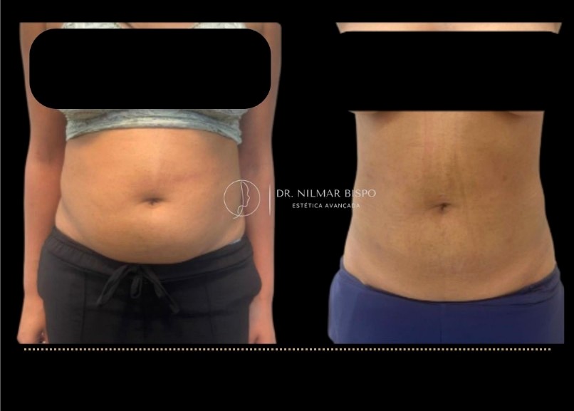 Antes e depois Endolaser abdômen