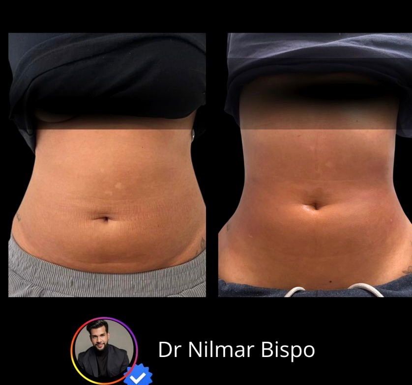 Antes e depois Endolaser flancos