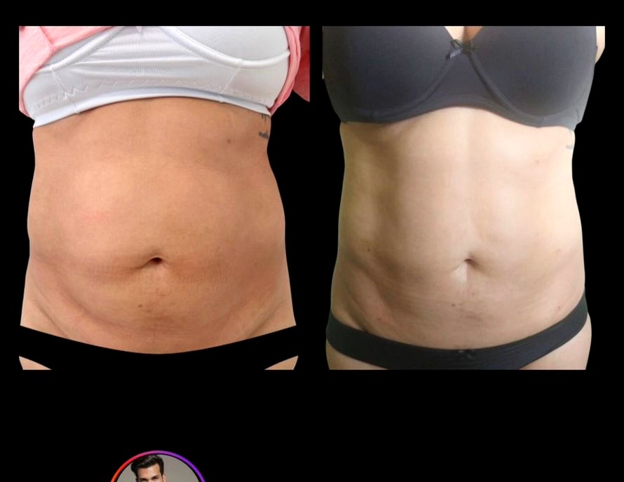 Antes e depois Endolaser flacidez