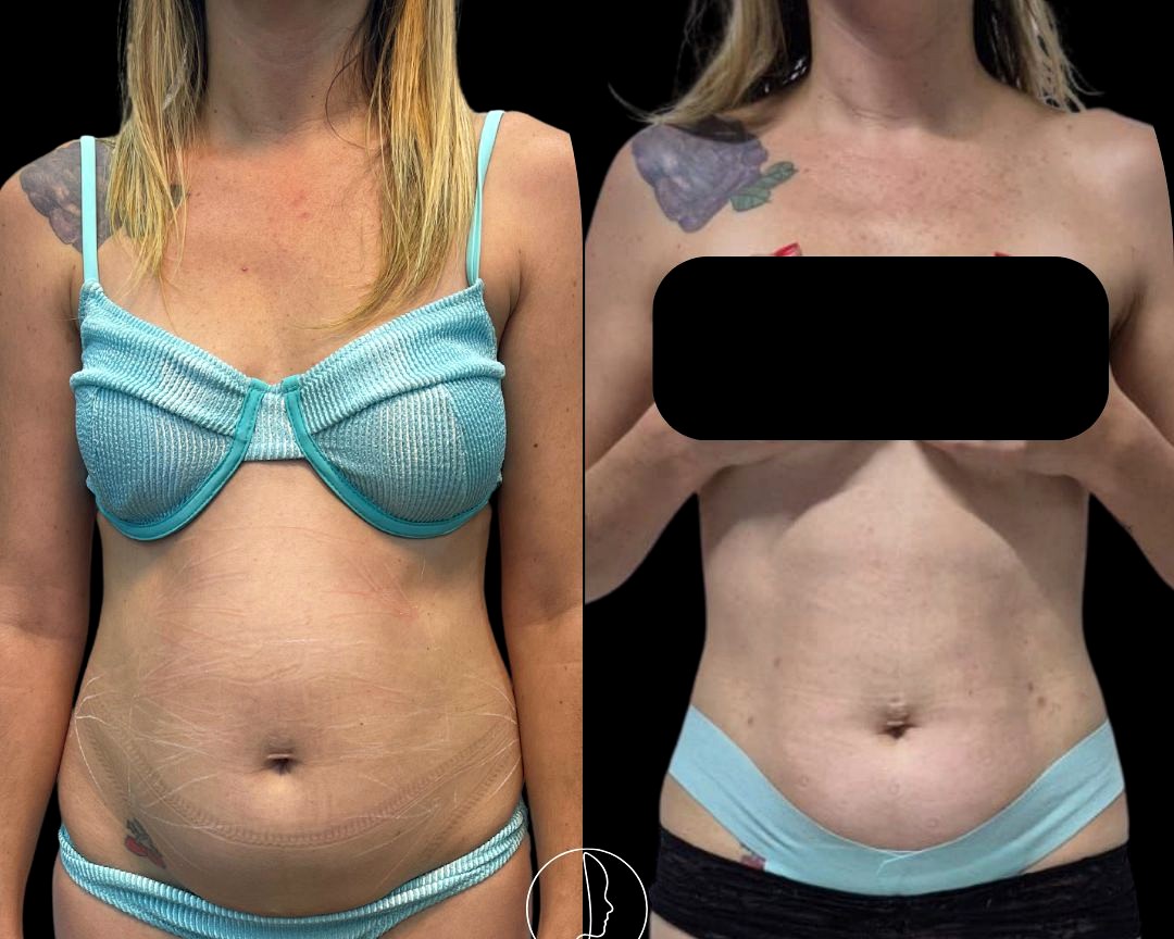 Antes e depois Endolaser corpo inteiro