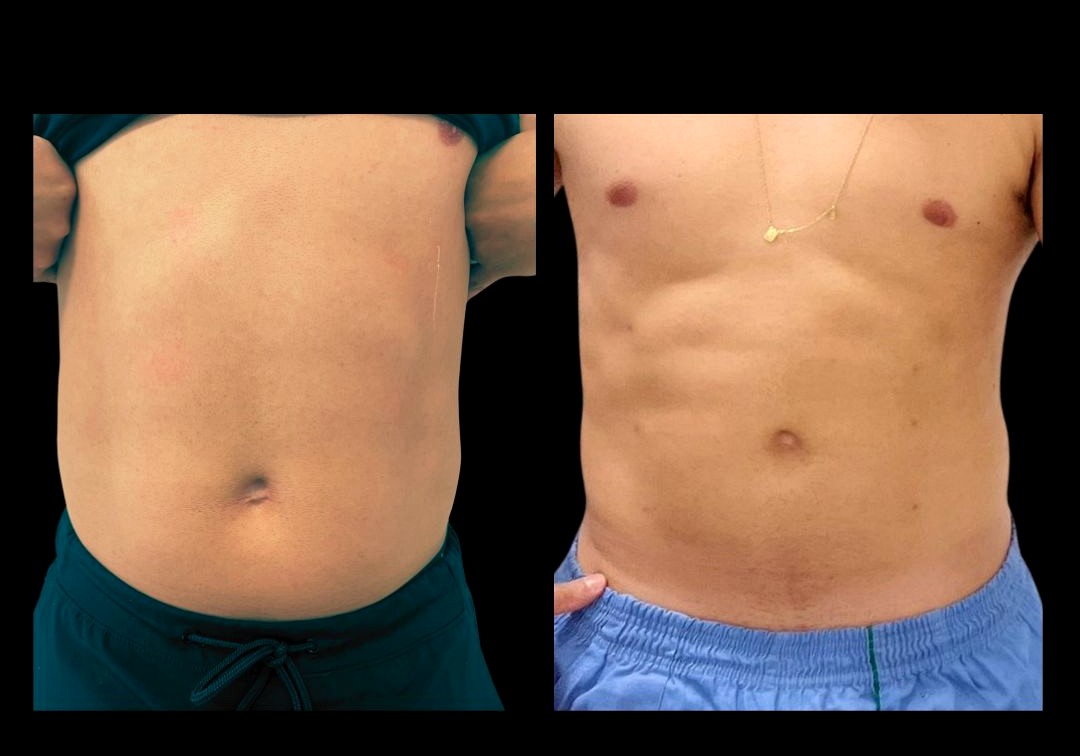 Antes e depois Endolaser masculino